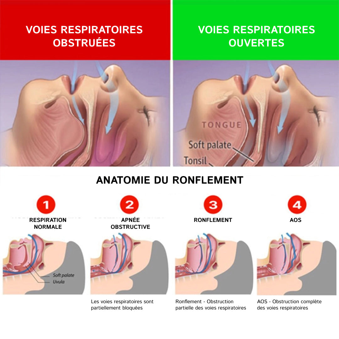 Quietmex Appareil Anti Ronflement
